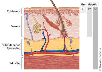 The epidermis, dermis, subcutaneous tissue and muscle and the corresponding burn degrees