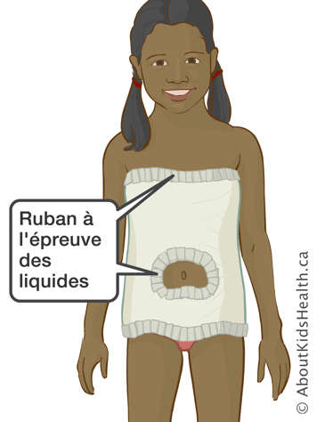 Enfant portant un plâtre corporel avec ruban à l’épreuve des liquides sur le torse