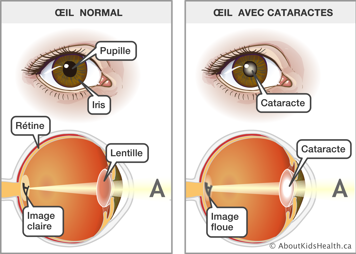 Œil normal voyant une image claire et œil avec cataracts voyant une image floue