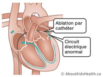 Exemple d'un coœur avec un cathéter inséré et un circuit électrique anormal