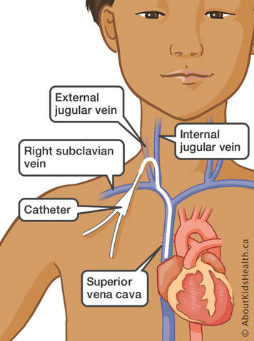 Catheter inserted into superior vena cava through the internal jugular vein, external jugular vein or right subclavian vein