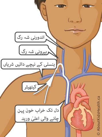 (catheter)ڑی رگ میں داخل کی گئی کیتھیٹر