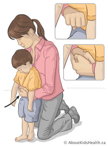 Woman kneeling to give Heimlich maneuver to standing child