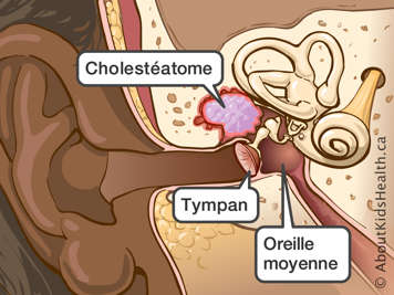 L’emplacement du cholestéatome, de l’oreille moyenne et du tympan