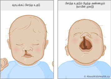 மூக்கு வரையான பிளவுபட்ட உதடுள்ள குழந்தை மற்றும் பிளவுபட்ட உதட்டையும் அண்ணத்தையும் காட்டும் வாய் திறந்துள்ள குழந்தை