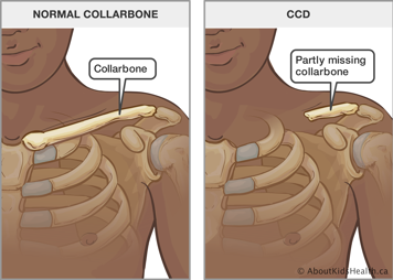 Upper body with normal collarbone and an upper body with partly missing collarbone