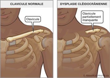 La partie supérieure du corps avec clavicule normale et la partie supérieure du corps avec clavicule partiellement manquante