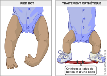 Bébé avec pied bot et bébé portant des orthèses à l’aide de bottes et d’une barre