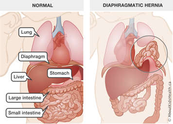 Baby with normal lung, diaphragm, liver, stomach, and small and large intestines, and a baby with lower organs in the chest