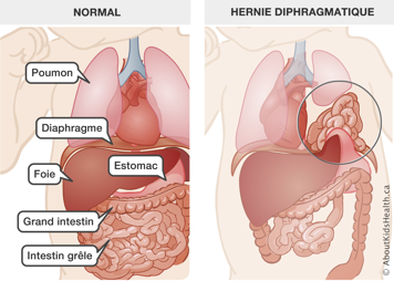 B&eacute;b&eacute; avec l&rsquo;emplacement normal des organes, compar&eacute; &agrave; un b&eacute;b&eacute; avec les organes abdominaux dans la cavit&eacute; thoracique