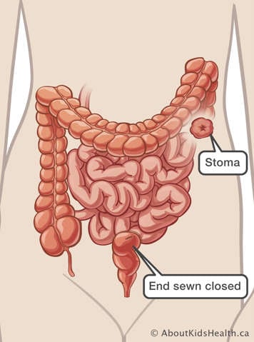 Medical illustration of end ostomy with stoma outside abdomen near top of bowel and other end sewn closed in lower abdomen