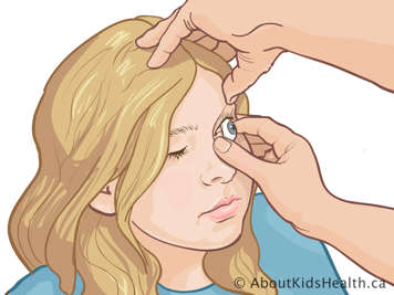 Placing an artificial eye under the upper eyelid while holding the upper eyelid open with the other hand