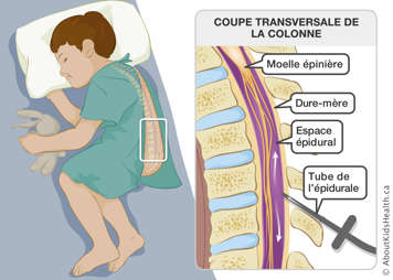 Coupe transversale de la colonne montrant la moelle épinière, la dure-mère, l’espace épidural et le tube de l’épidurale