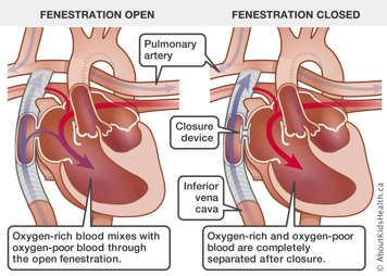 Blood flow through a heart with open fenestration compared to blood flow through a heart with a closure device