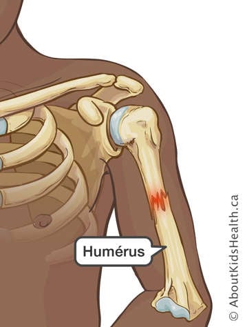 Fracture vers le milieu du haut du bras