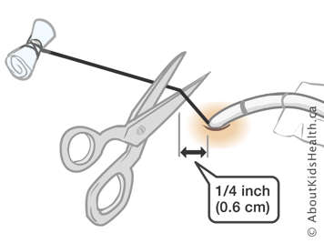 Cutting retention suture a quarter inch away from the C-tube site