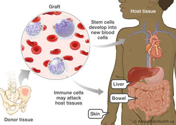 Illustration of stem cells from a graft developing into new blood cells and immune cells attacking host tissues