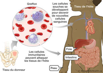 Des cellules souches devenant de nouvelles cellules sanguines et des cellules immunitaires attaquant les tissus de l’hôte