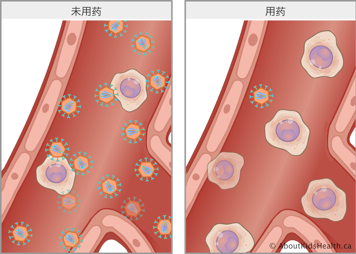 未用药情况下，血液中有若干HIV细胞；用药后，血液中仅有一个HIV细胞