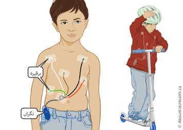 سکوٹر پر سوار ایک بچہ جس نےکپڑوں کے نیچے ایک مانیٹر اور الیکٹروڈز پہنے ہوئے ہیں