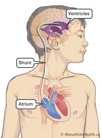 A shunt through the ventricles in the brain leading to the heart