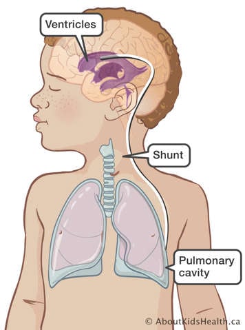 A shunt through the ventricles in the brain leading to the pleural space