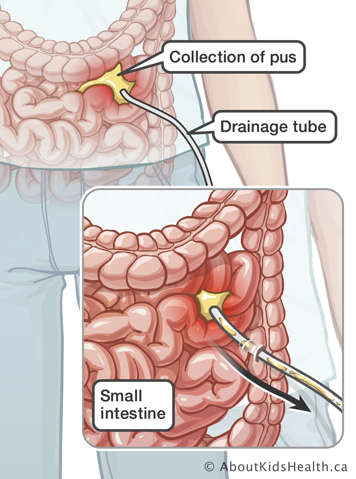 Collection of pus exiting through a drainage tube in the small intestine