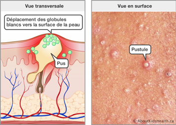 Vue transversale du pus sous le peau et le déplacement des globules blancs vers la surface, et la vue en surface des pustules