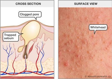 Cross section of skin with a trapped sebum and clogged pore, and a surface view of skin with whiteheads