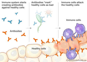 Immune system creates antibodies, antibodies “mark” healthy cells as bad, immune cells attack healthy cells