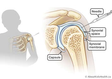 Needle inserted into synovial space in shoulder joint