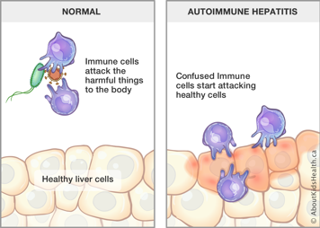 Immune cells attacking harmful things in normal body and confused immune cells attacking liver cells in autoimmune hepatitis