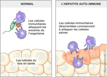 Cellules imminutaires attaquant les ennemis du corps et des cellules immunitaires désorientées attaquant les cellules saines