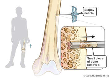 Biopsy needle removing a small piece of bone