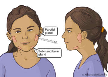 Needle inserted into parotid gland in girl&rsquo;s cheek