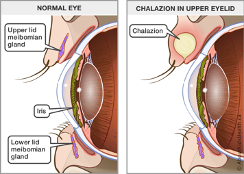 Upper and lower lid melbomian glands in a normal eye and an eye with a chalazion in the upper eyelid