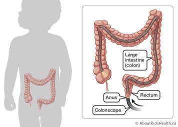 Colonscope inserted through anus into rectum and large intestine (colon)