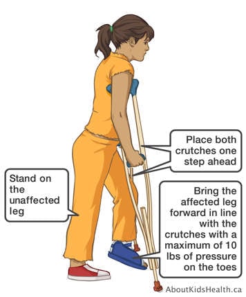 Using crutches to step forward with the affected leg with a maximum of ten pounds of pressure on the toes of that leg