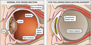 The anatomy of a normal eye and a diagram of an eye after enucleation surgery