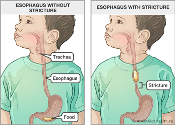 Esophagus without stricture and esophagus with stricture