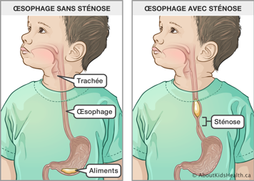 Œsophage sans sténose et œsophage avec sténose