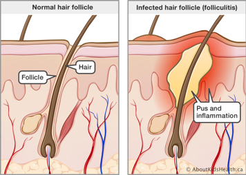 Cross section of skin with normal hair follicle and cross section of skin with infected hair follicle (folliculitis)