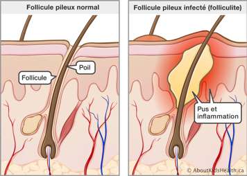 Coupe transversal de la peau avec follicule pileux normal et coupe transversal de la peau avec follicule pileux infecté