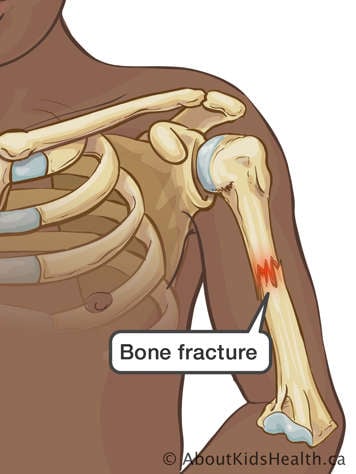 Fracture in middle of upper arm