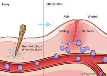 Splinter in the skin causing pain, warmth, redness and swelling