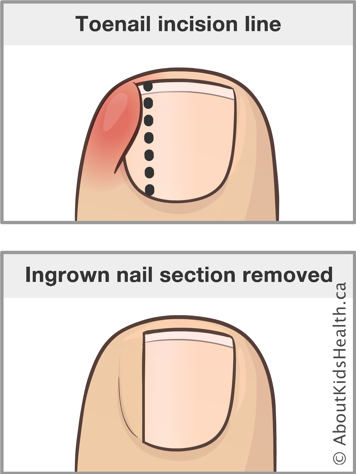 Illustration of incision line over an ingrown toenail and of toenail with ingrown nail section removed