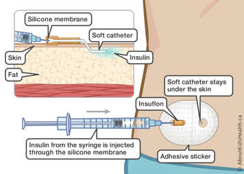 A soft catheter under the skin with a silicone membrane on the outside for injecting insulin from a syringe