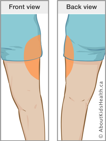 Front view and back view of marking on thigh indicating insulin injection site