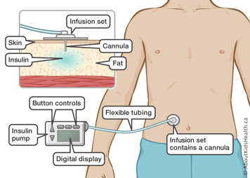 Insulin pump with button controls, digital display, flexible tubing, and infusion set containing a cannula