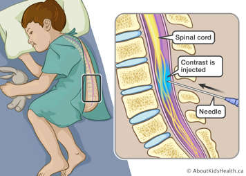 Needle injecting contrast into child&rsquo;s spinal canal